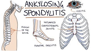 Ankylosing Spondylitis Visual Explanation for Students [upl. by Palecek]