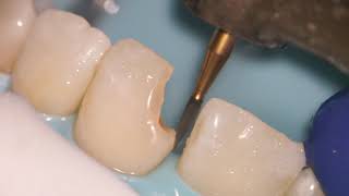 Teeth Bonding  Front tooth filling EXPLAINED [upl. by Thekla]