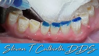 Bonding Worn Anterior Teeth  Dental Minute with Dr Steven T Cutbirth DDS [upl. by Akinna]