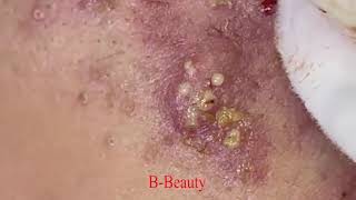 Pimple Removal and Acnes Treatment  BBeauty 07 [upl. by Alyled]