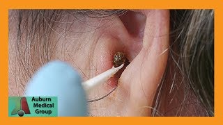 Chunky Earwax Removal  Auburn Medical Group [upl. by Myrtie]