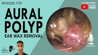 739  Infected Aural Polyp Ear Wax Removal [upl. by Yentnuoc]