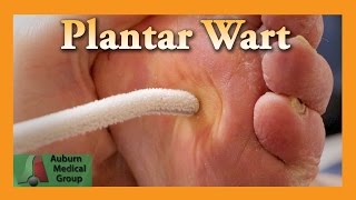 Plantar Wart Treatment  Auburn Medical Group [upl. by Aseela]