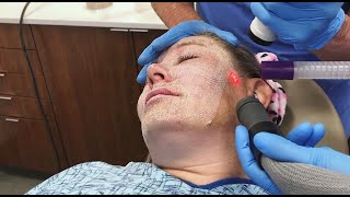 Full Face Fractional CO2 Laser Resurfacing for Wrinkles and Skin Tightening [upl. by Goodard]