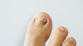 How to prevent and treat nail fungus [upl. by Savinirs]