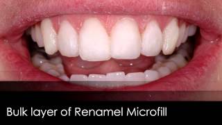 Composite Veneers  Enamel Replacement [upl. by Tingley]