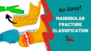 Mandibular Fracture Classification  DENTAL NOTES [upl. by Assenyl155]