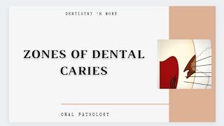 DENTAL CARIES ZONES [upl. by Anuska]