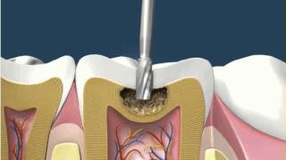 Dental Fillings White Amalgam 1 [upl. by Congdon]