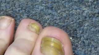 My Toenail Fungus Sucess Story [upl. by Kcirddehs677]