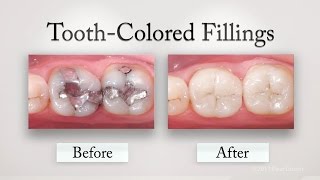 Tooth Colored Fillings [upl. by Etnaud307]