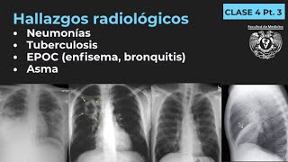 043  Neumonía TB EPOC Enfisema Bronquitis Bronquiectasias Asma [upl. by Ysak]