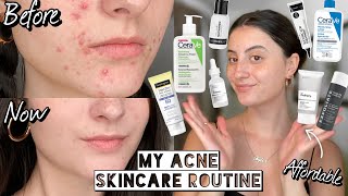 How I Cleared My HORMONAL ACNE amp SCARRING with Affordable Skincare  Dry amp Sensitive Skin [upl. by Erich860]