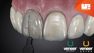 Uveneer® Procedure Animation  Direct Veneer Template System [upl. by Erdnael519]