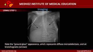 Respiratory Distress Syndrome in Neonates Hyaline Membrane Disease [upl. by Oirevlis]