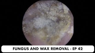 FUNGAL EAR INFECTION AND EAR WAX REMOVAL  EP 42 [upl. by Annodahs]