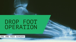 Drop Foot Operation Pre and Post Surgery Testimonial [upl. by Niwre]