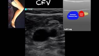 POCUS  Lower Extremity Deep Venous Thrombosis DVT  Updated [upl. by Leamiba356]