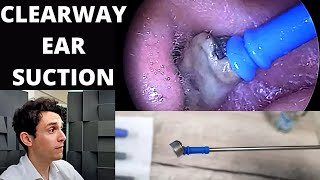 Soft Tip Suction Probe Used to Extract Dead Skin From Ears Clearway Suction Tool [upl. by Nerac]