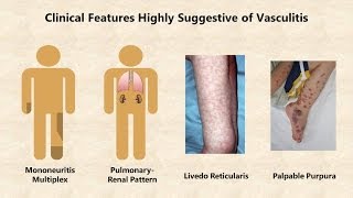 Vasculitis  An Overview [upl. by Jemma]