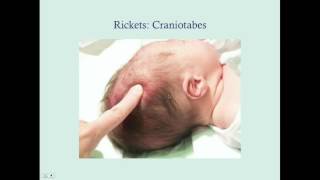 Rickets  CRASH Medical Review Series [upl. by Yonita105]