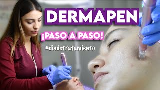 DERMAPEN  TRATAMIENTO DE MICRONEEDLING  Ximena Ramaya [upl. by Benedikt]