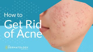 Acne Treatment  Explained by Dermatologist [upl. by Farrell268]