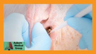 Chucks Tough Ear Wax Removal Part 1  Auburn Medical Group [upl. by Rutan298]