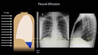 How to Interpret a Chest XRay Lesson 6  Diaphragm and Pleura [upl. by Wallack]