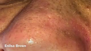 Blackheads Extractions and Acne Treatment on Daryl [upl. by Hermine]