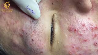 Treatment of acne tablets pustules and blackheads 360  Loan Nguyen [upl. by Nrubloc745]